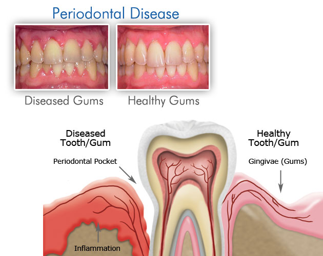 Gum and Periodontal Treatment