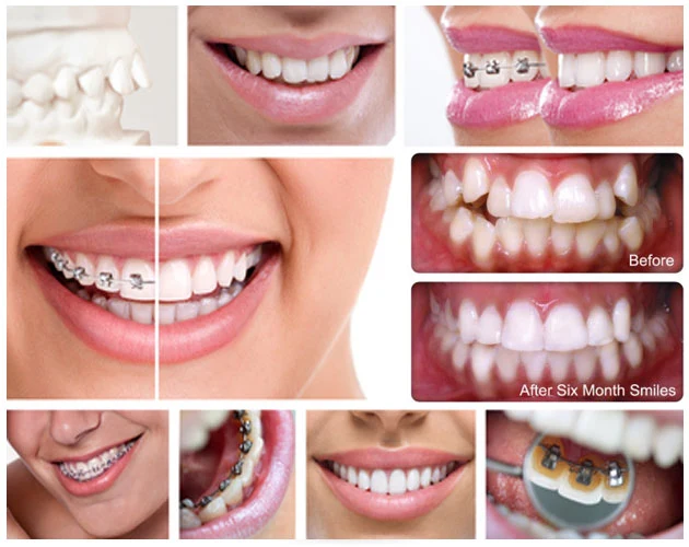 Orthodontics (Braces)
