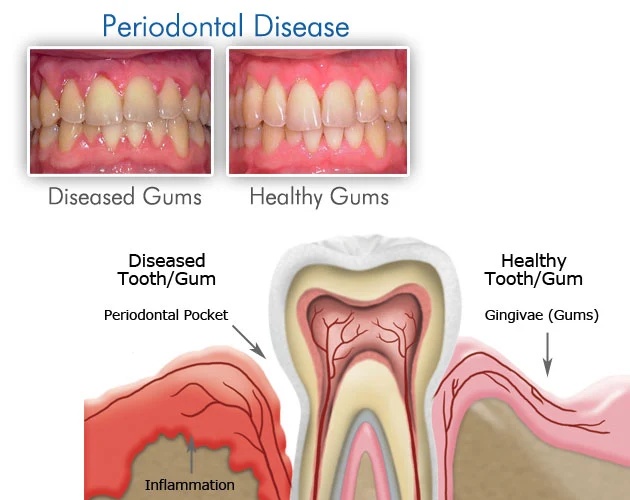 Gum Treatment